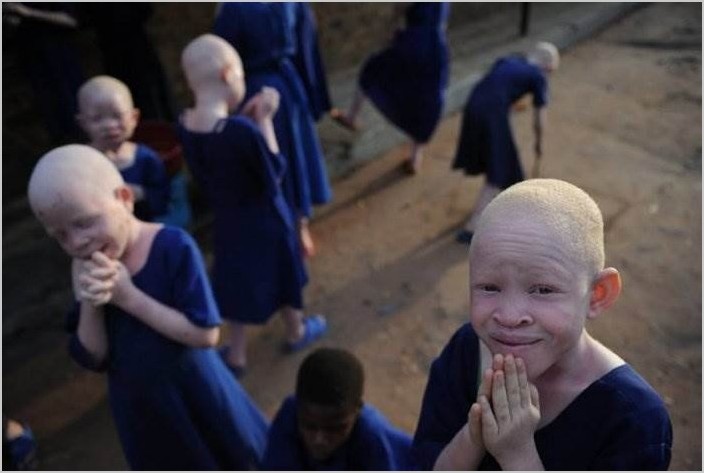 Альбиносы в Африке