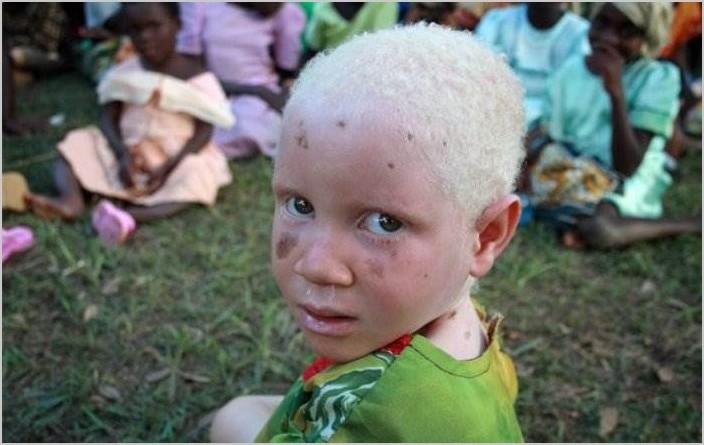 Альбиносы в Африке