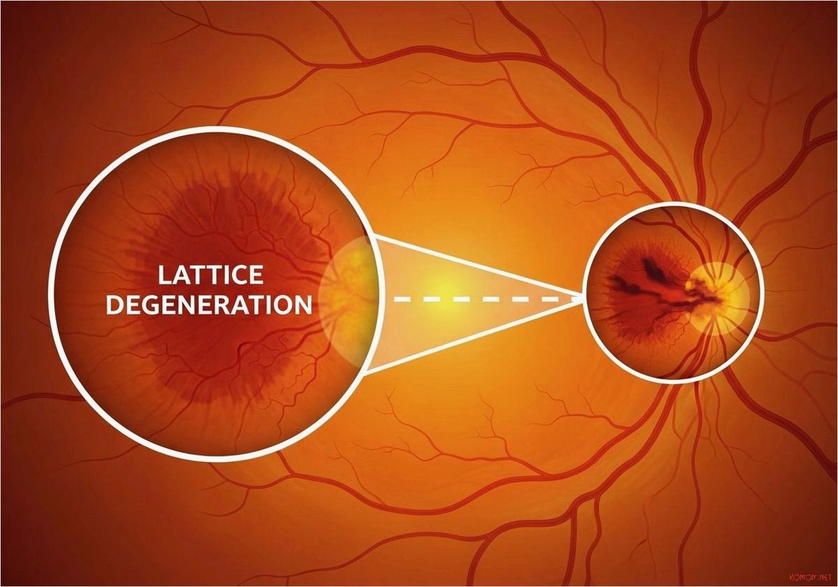 Лечение дистрофии пигментного эпителия сетчатки с трансплантацией собственных стволовых клеток в современной офтальмологии